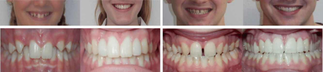 missing lateral incisors