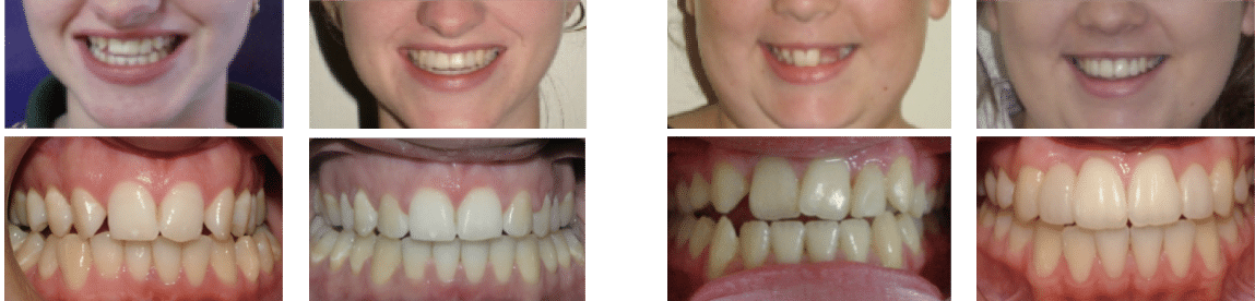 missing lateral incisors