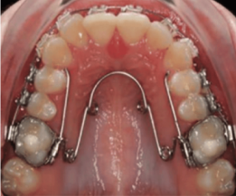 Palate Expander: Uses, Types & Adjusting