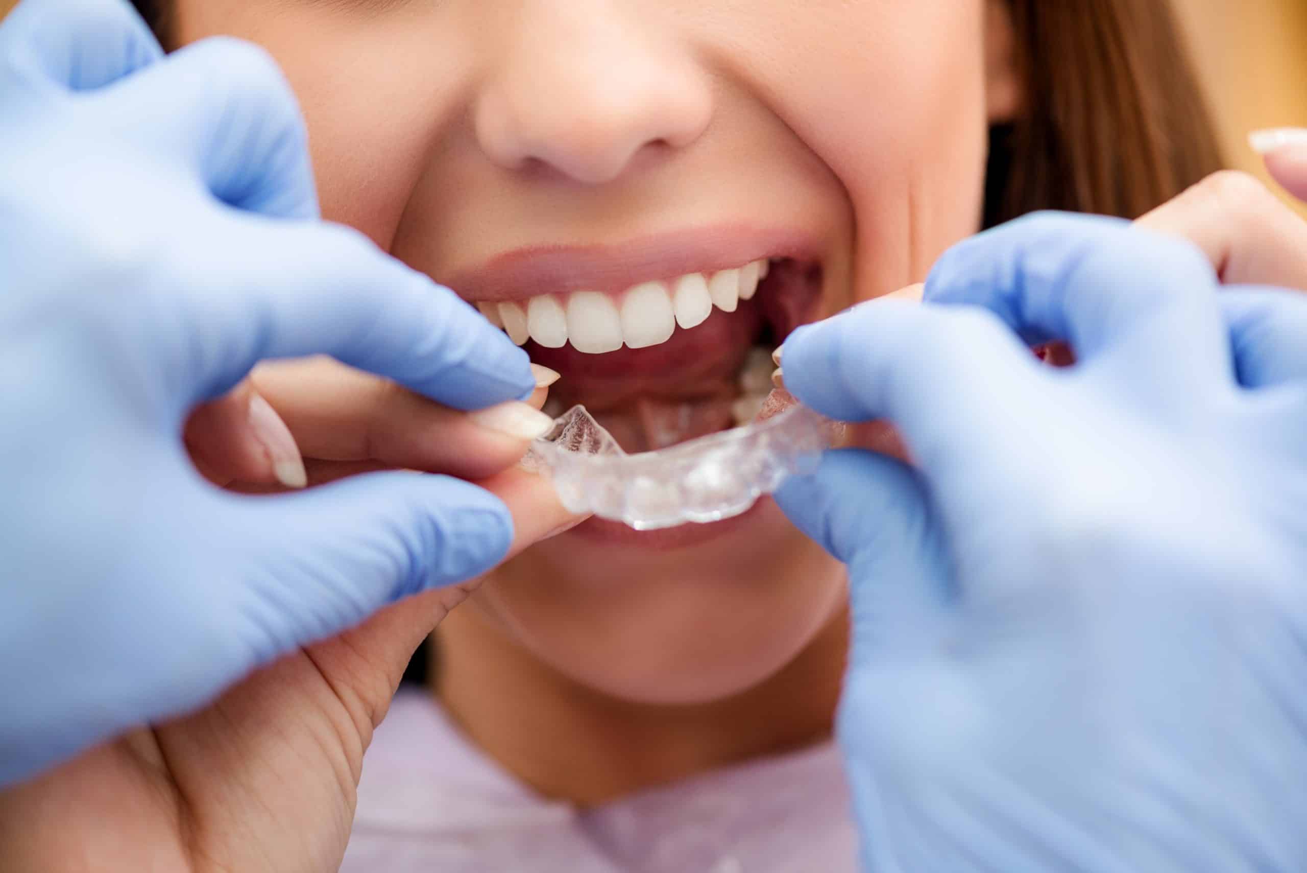 What Happens if Your Teeth Shift After Braces?