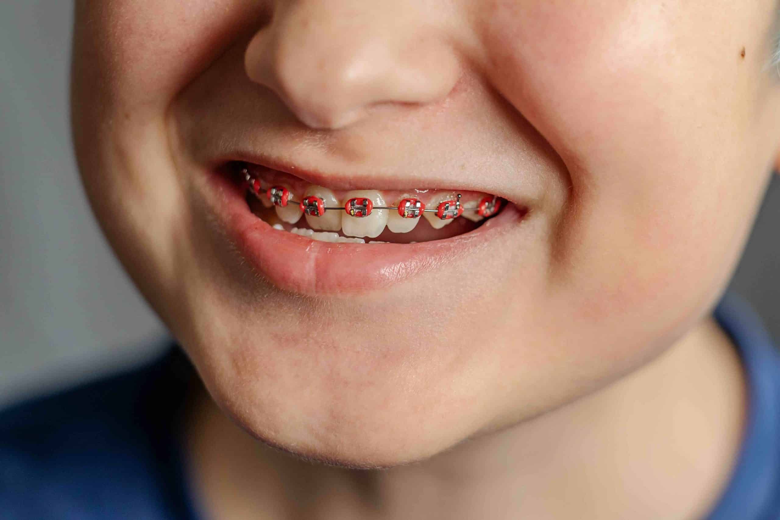 At What Age Should My Child Get Braces?